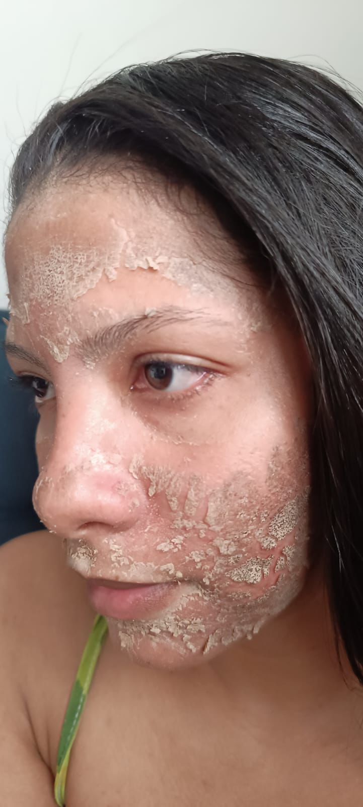 Fase descamacao - Rosto