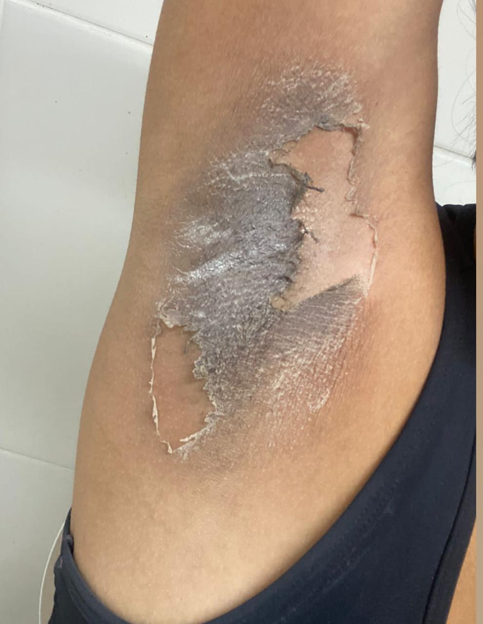 Fase descamacao - Axila escura