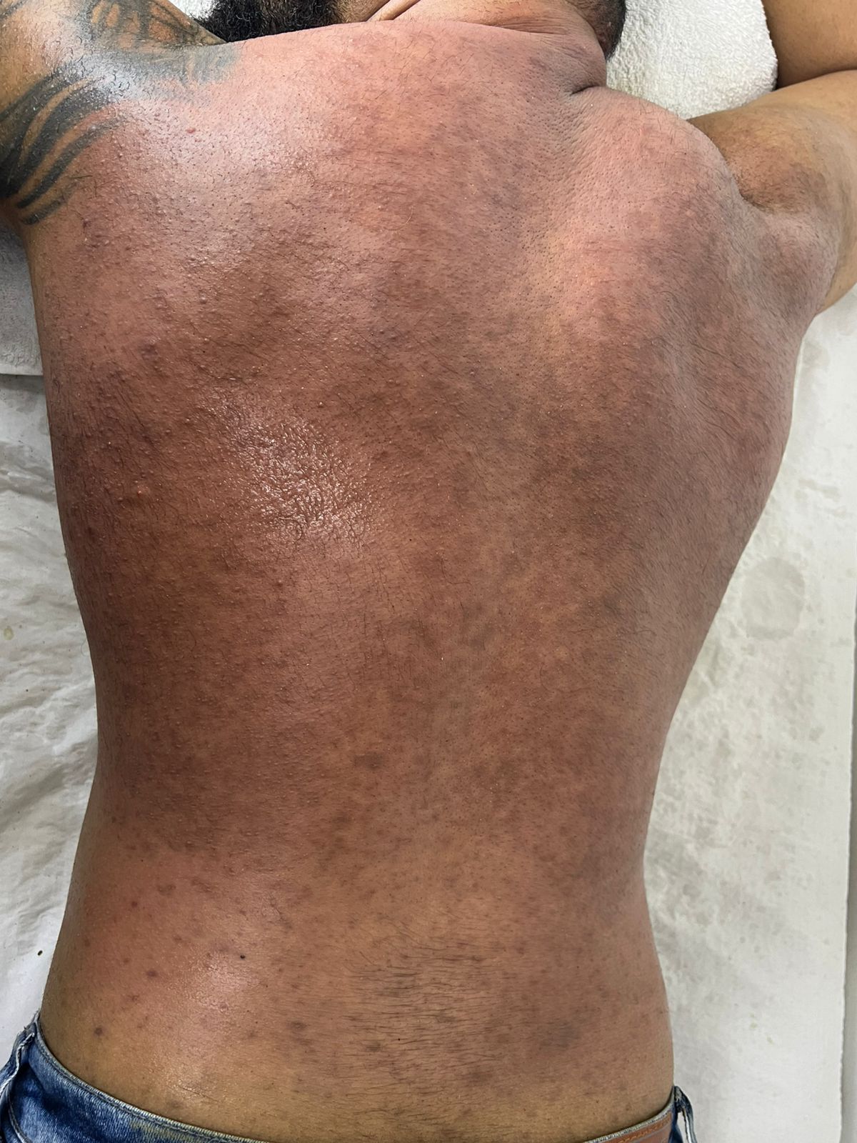 Fase inflamatoria - Costas