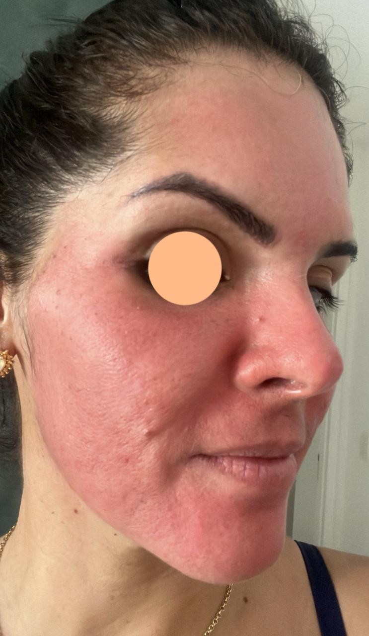 Fase inflamatoria - Rosto