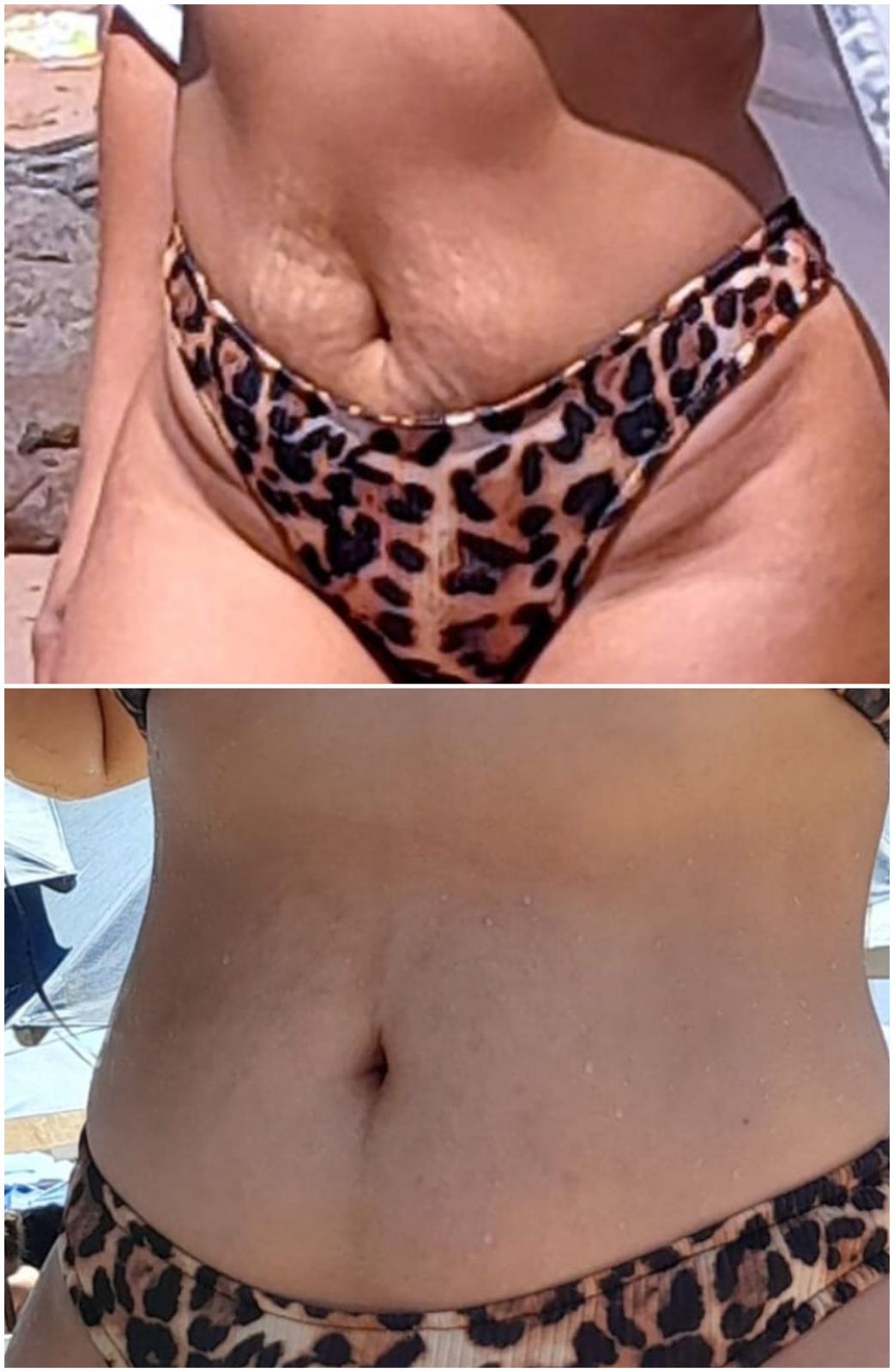 Micropuntura de estrias - Barriga antes e depois