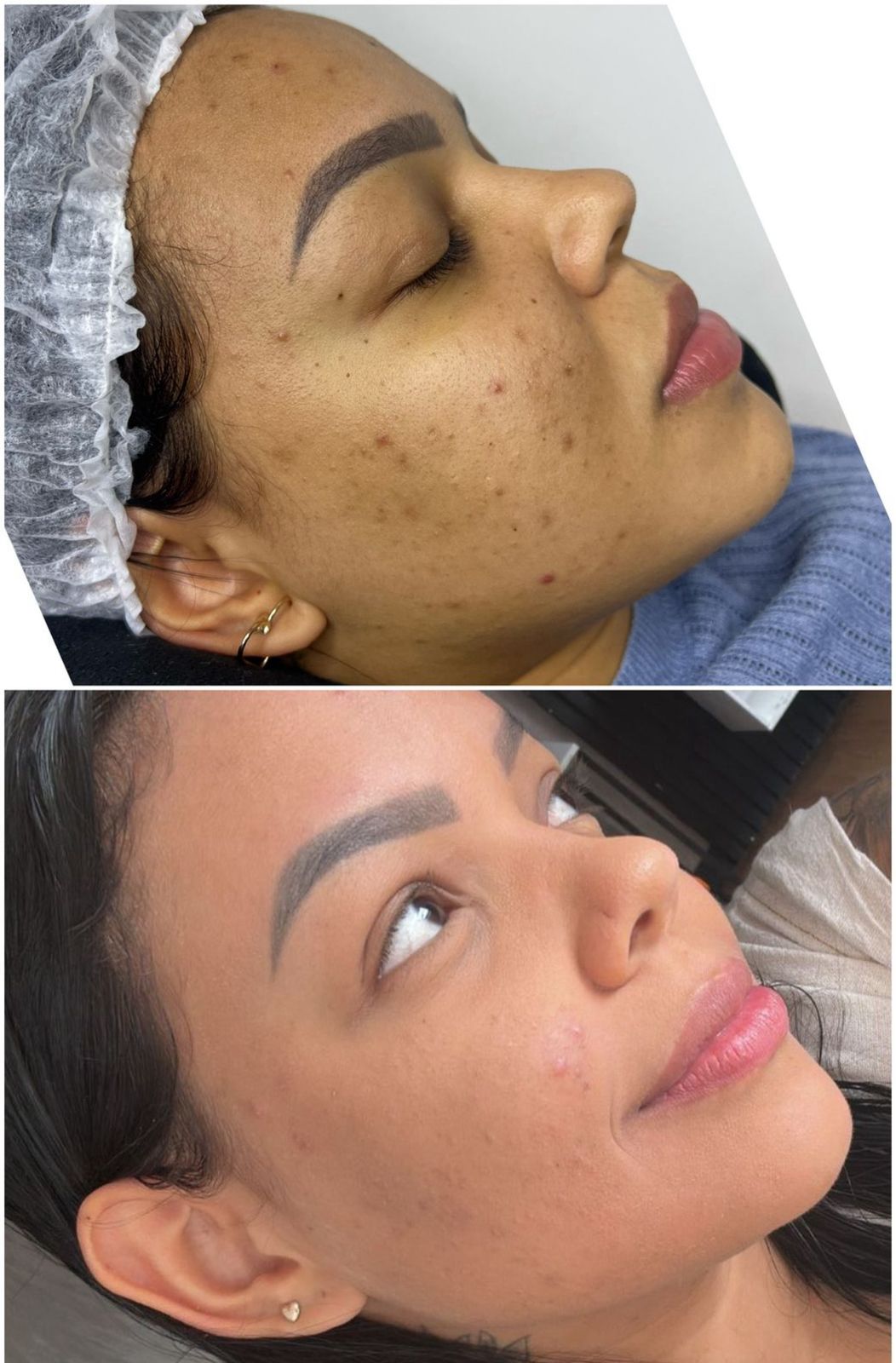 Resultado facial - antes e depois