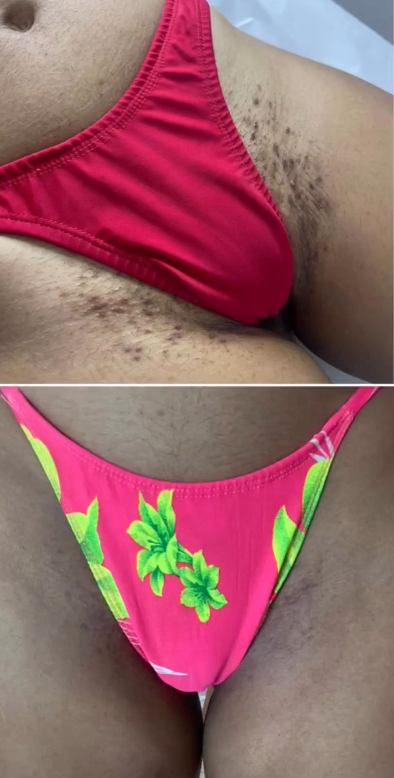Resultado virilha - antes e depois clareamento