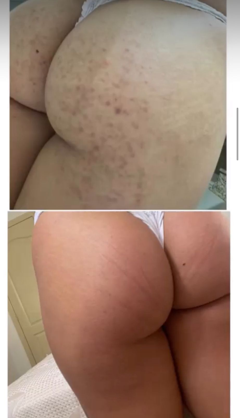 Resultado gluteo - antes e depois foliculite