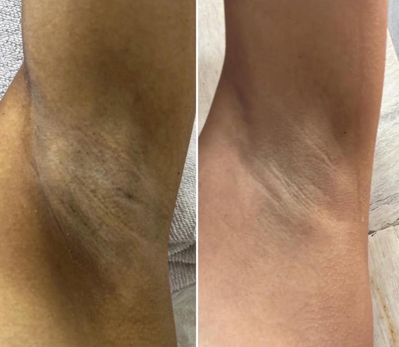 Resultado axila - antes e depois clareamento