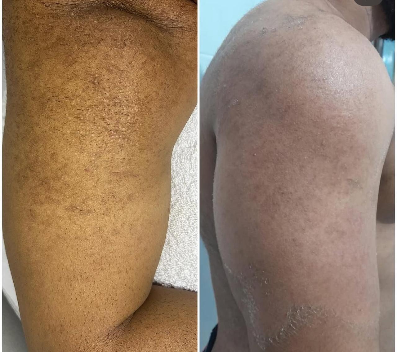 Resultado braco - antes e depois