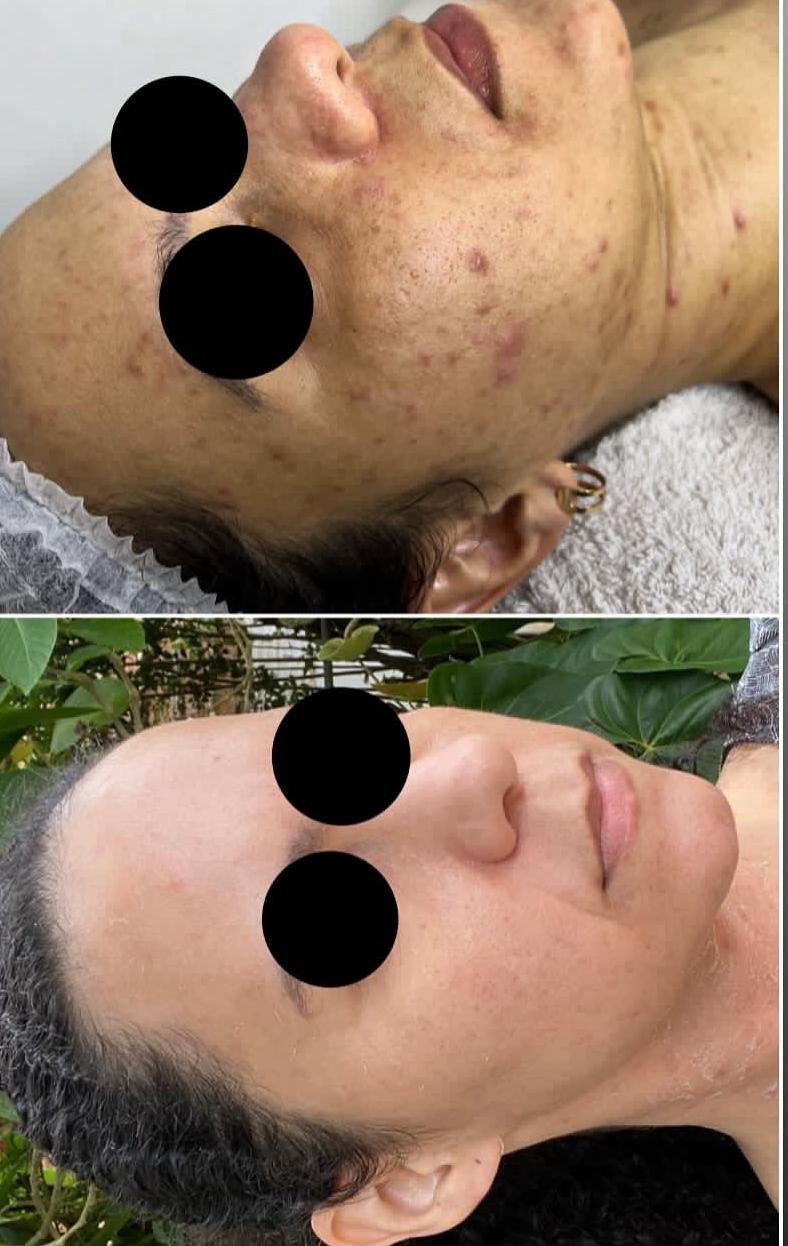Resultado - Clareamento Facial